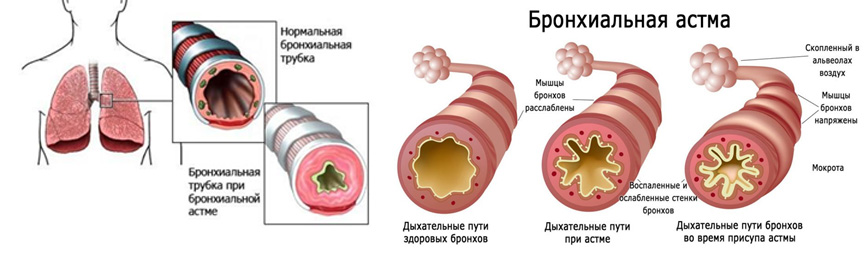 Что такое бронхоспазм?